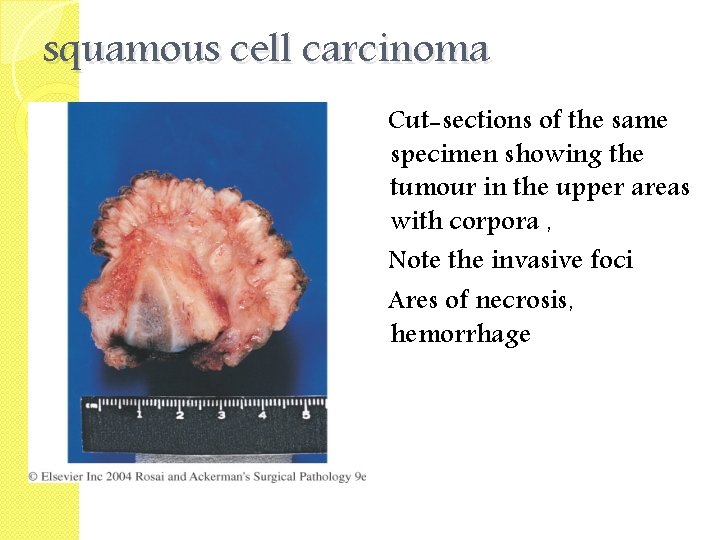 squamous cell carcinoma Cut-sections of the same specimen showing the tumour in the upper