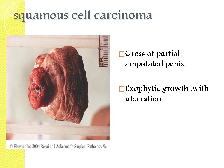 squamous cell carcinoma �Gross of partial amputated penis, �Exophytic growth , with ulceration. 