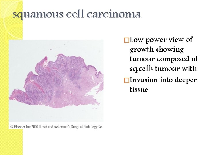 squamous cell carcinoma �Low power view of growth showing tumour composed of sq. cells