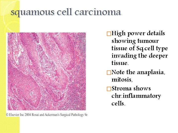 squamous cell carcinoma �High power details showing tumour tissue of Sq. cell type invading