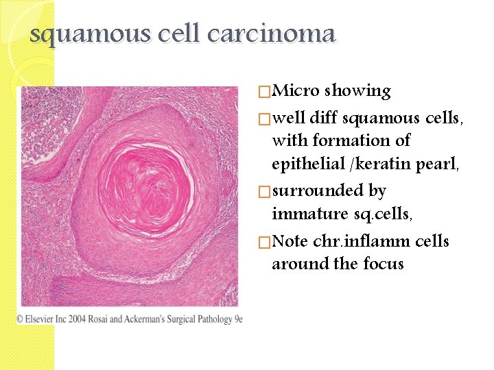 squamous cell carcinoma �Micro showing �well diff squamous cells, with formation of epithelial /keratin