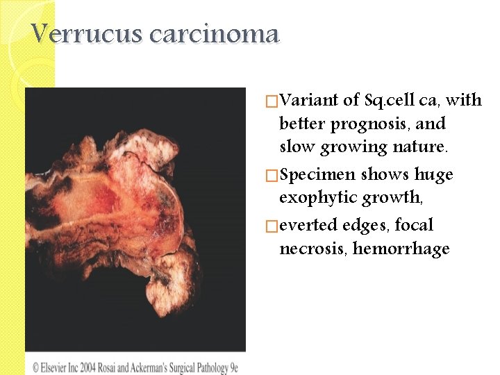 Verrucus carcinoma �Variant of Sq. cell ca, with better prognosis, and slow growing nature.