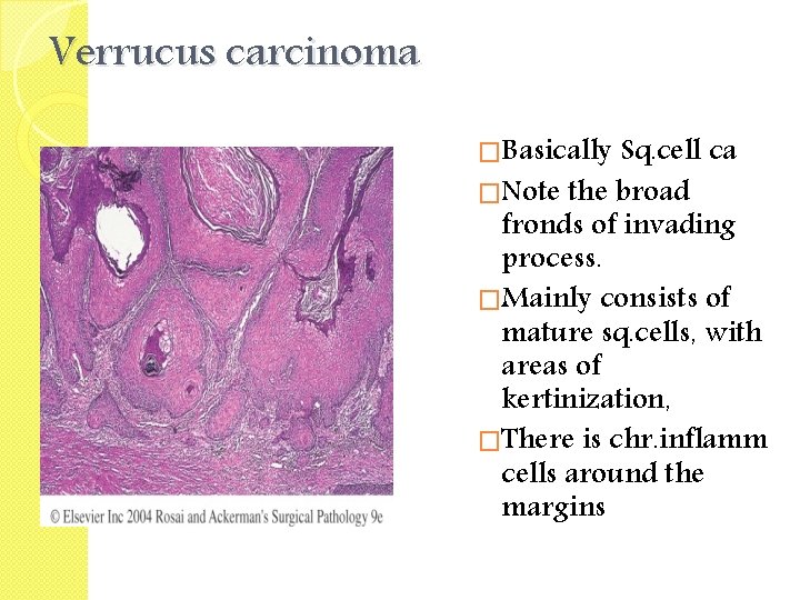 Verrucus carcinoma �Basically Sq. cell ca �Note the broad fronds of invading process. �Mainly
