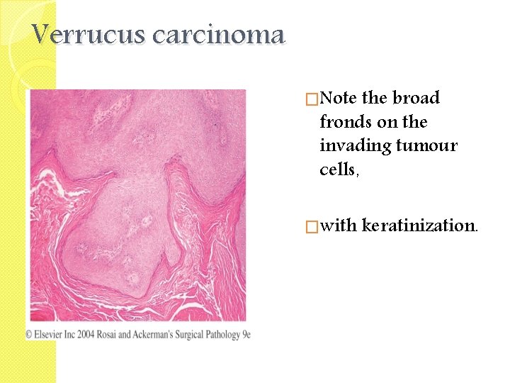 Verrucus carcinoma �Note the broad fronds on the invading tumour cells, �with keratinization. 