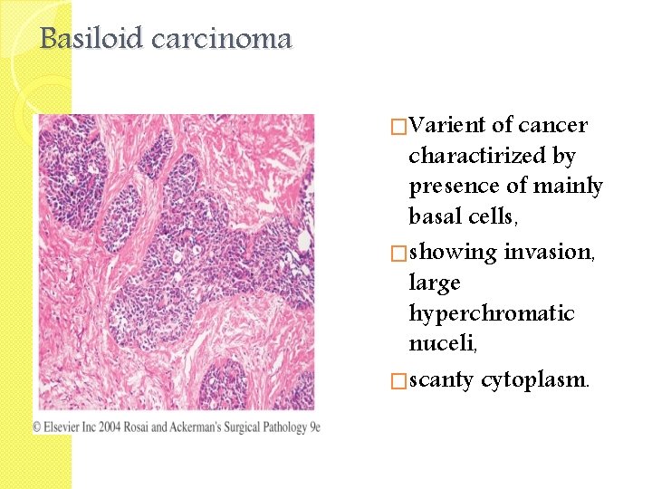 Basiloid carcinoma �Varient of cancer charactirized by presence of mainly basal cells, �showing invasion,