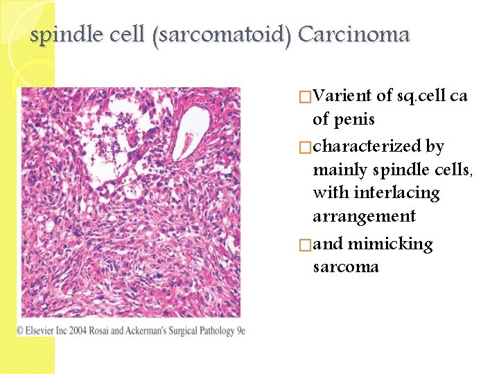 spindle cell (sarcomatoid) Carcinoma �Varient of sq. cell ca of penis �characterized by mainly