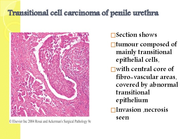 Transitional cell carcinoma of penile urethra �Section shows �tumour composed of mainly transitional epithelial