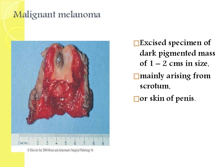 Malignant melanoma �Excised specimen of dark pigmented mass of 1 – 2 cms in