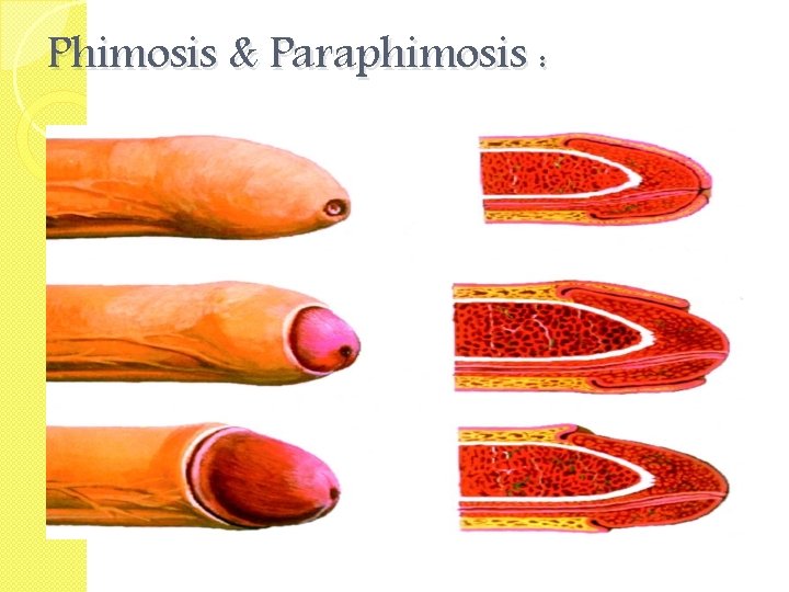 Phimosis & Paraphimosis : 