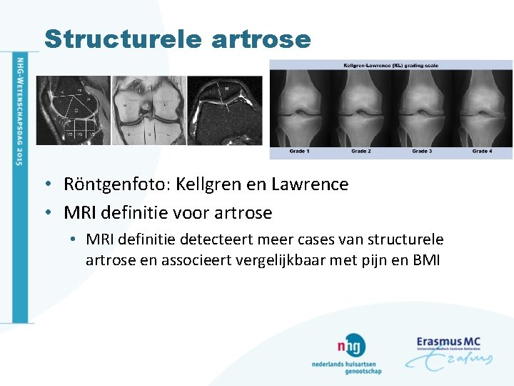 Structurele artrose • Röntgenfoto: Kellgren en Lawrence • MRI definitie voor artrose • MRI