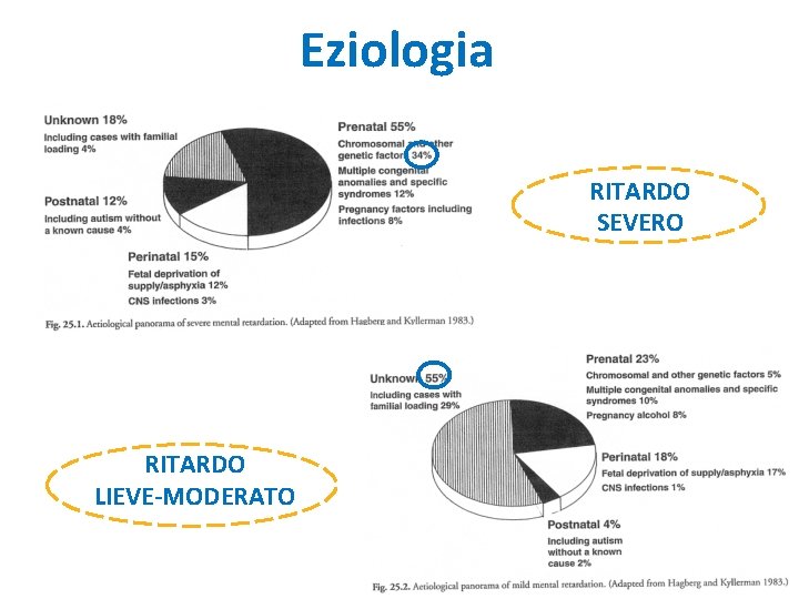 Eziologia RITARDO SEVERO RITARDO LIEVE-MODERATO Eziologia RITARDO SEVERO RITARDO LIEVE-MODERATO