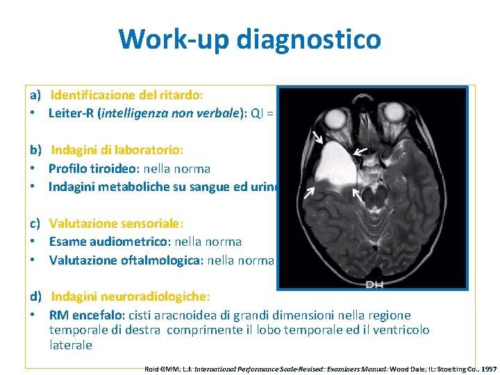 Work-up diagnostico a) Identificazione del ritardo: • Leiter-R (intelligenza non verbale): QI = 65 Work-up diagnostico a) Identificazione del ritardo: • Leiter-R (intelligenza non verbale): QI = 65