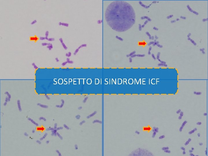 Work-up diagnostico e) Indagini genetiche: • X-fragile: non evidenza di espansione della tripletta CGG Work-up diagnostico e) Indagini genetiche: • X-fragile: non evidenza di espansione della tripletta CGG
