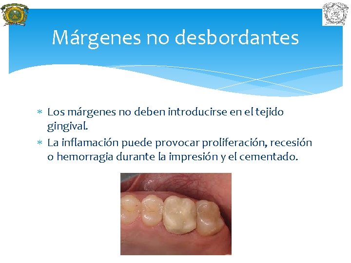 Márgenes no desbordantes Los márgenes no deben introducirse en el tejido gingival. La inflamación