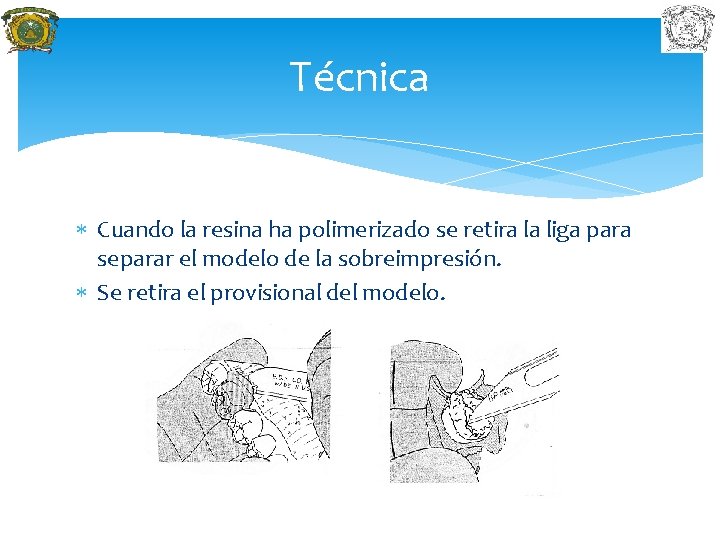 Técnica Cuando la resina ha polimerizado se retira la liga para separar el modelo