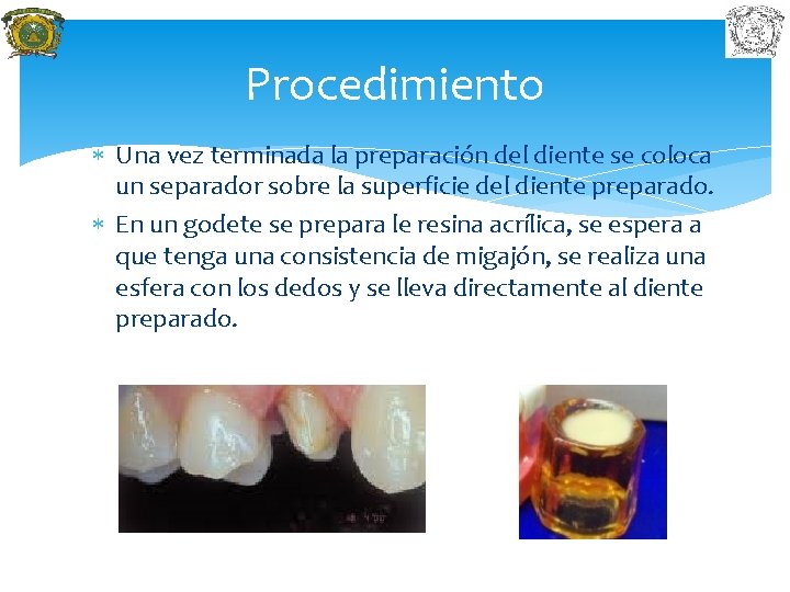 Procedimiento Una vez terminada la preparación del diente se coloca un separador sobre la