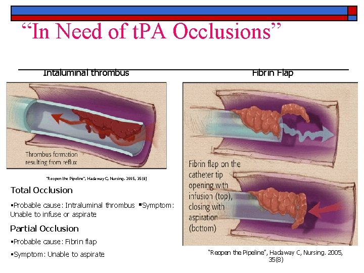 “In Need of t. PA Occlusions” Intaluminal thrombus Fibrin Flap “Reopen the Pipeline”, Hadaway