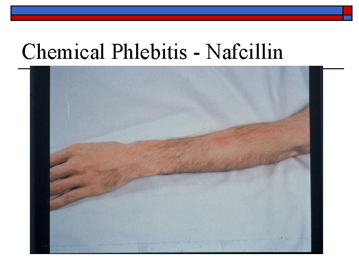 Chemical Phlebitis - Nafcillin 