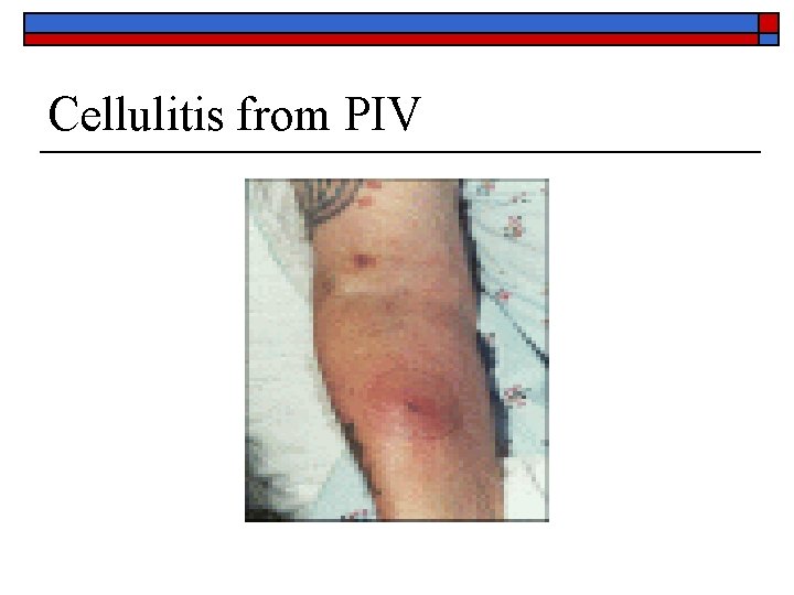 Cellulitis from PIV 