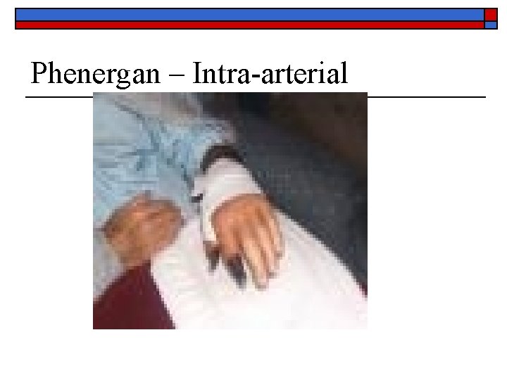 Phenergan – Intra-arterial 