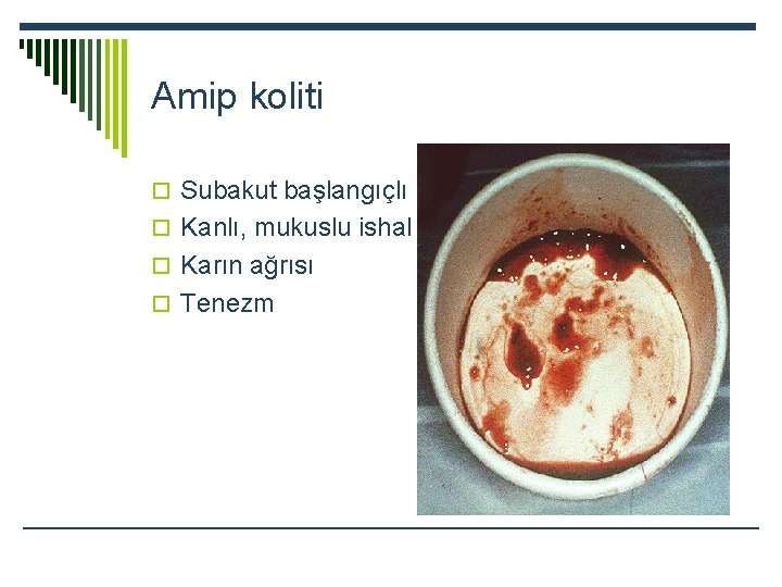 Amip koliti o Subakut başlangıçlı o Kanlı, mukuslu ishal o Karın ağrısı o Tenezm
