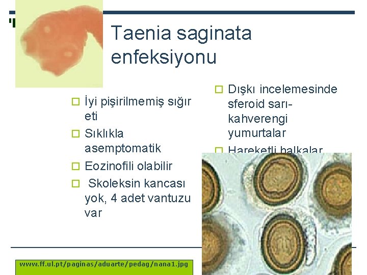 Taenia saginata enfeksiyonu o İyi pişirilmemiş sığır eti o Sıklıkla asemptomatik o Eozinofili olabilir