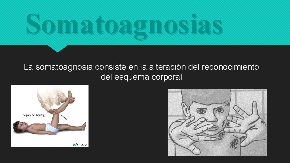 Somatoagnosias La somatoagnosia consiste en la alteración del reconocimiento del esquema corporal. 