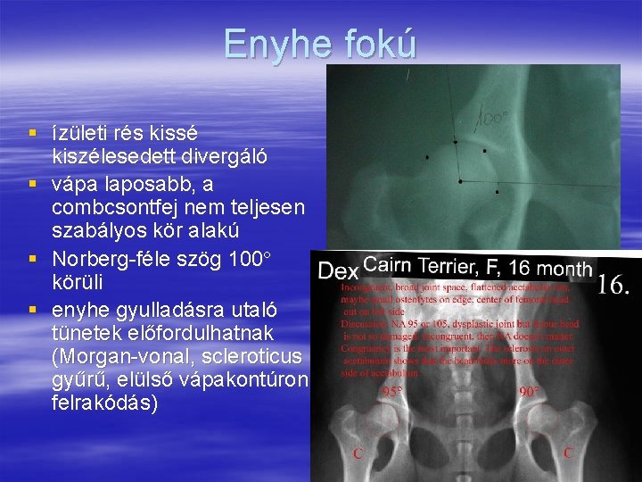 Enyhe fokú § ízületi rés kissé kiszélesedett divergáló § vápa laposabb, a combcsontfej nem