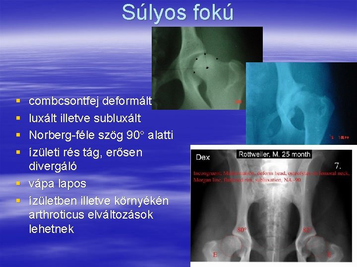 Súlyos fokú § § combcsontfej deformált luxált illetve subluxált Norberg féle szög 90 alatti