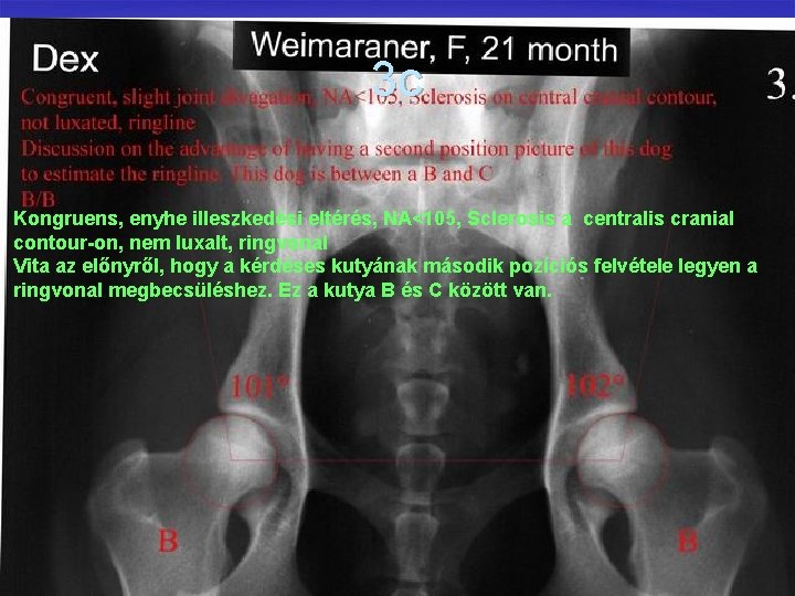 3 c Kongruens, enyhe illeszkedési eltérés, NA<105, Sclerosis a centralis cranial contour-on, nem luxalt,