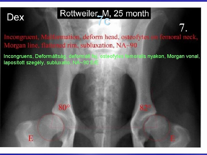 7 c Incongruens, Deformáltság, deformált fej, osteofytes femoralis nyakon, Morgan vonal, laposított szegély, subluxatio,