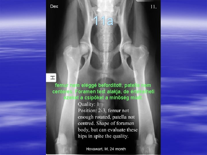 11 a femur nem eléggé befordított, patella nem centeres. Foramen test alakja, de értékelheti