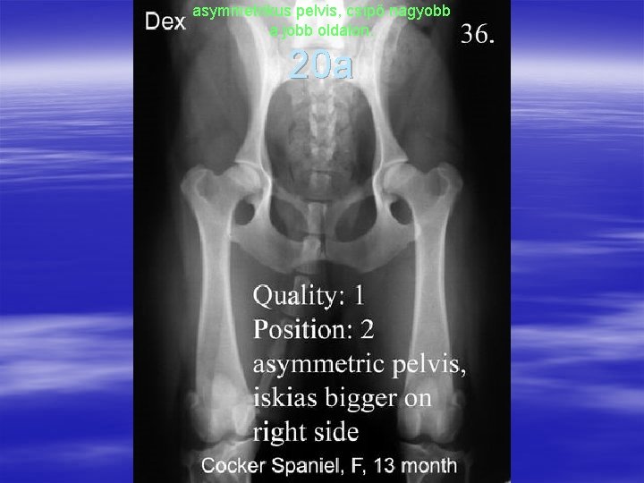 asymmetrikus pelvis, csípő nagyobb a jobb oldalon. 20 a 