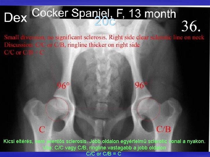 20 c Kicsi eltérés, nem jelentős sclerosis. Jobb oldalon egyértelmű sclerotic vonal a nyakon.