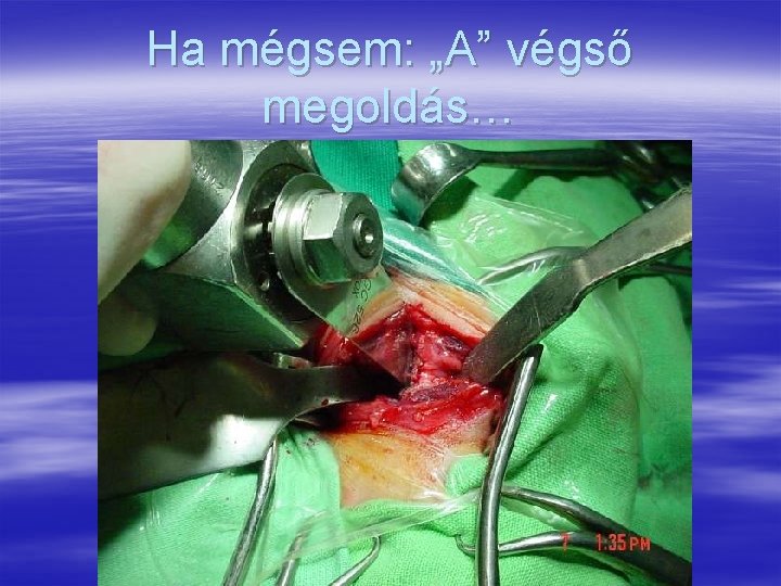 Ha mégsem: „A” végső megoldás… 