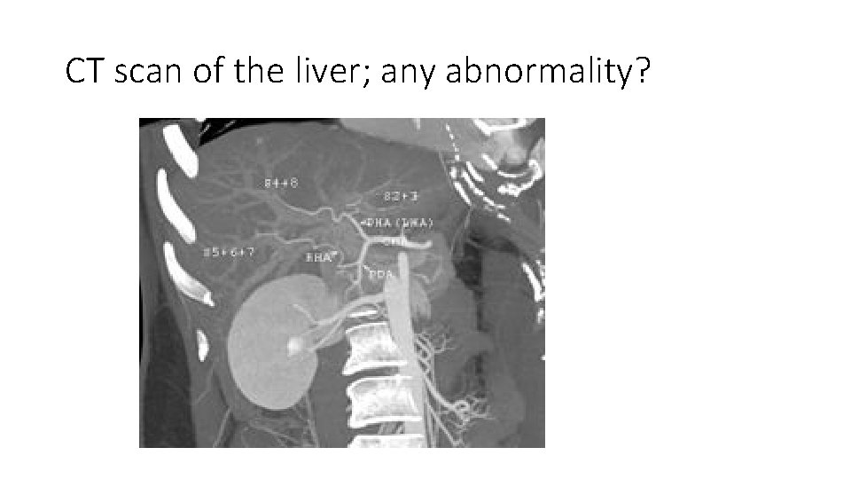 CT scan of the liver; any abnormality? 