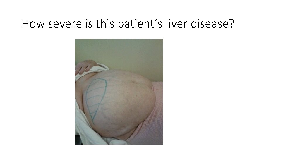 How severe is this patient’s liver disease? 