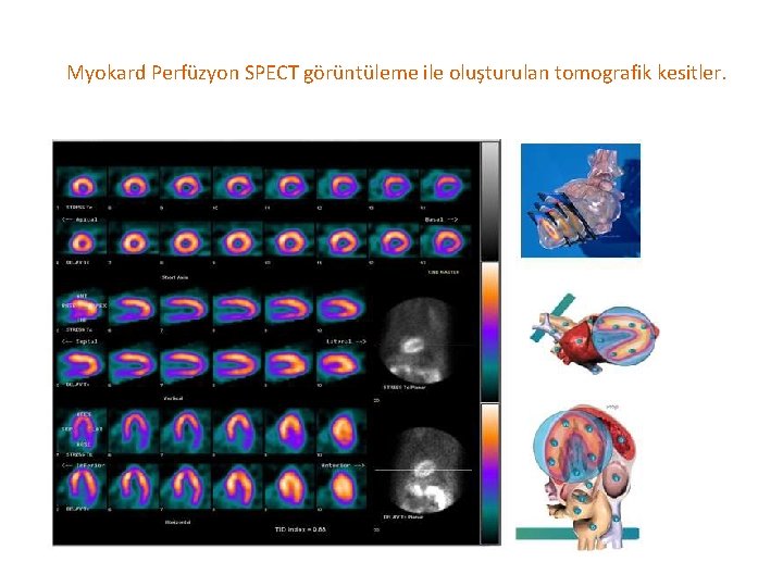 Myokard Perfüzyon SPECT görüntüleme ile oluşturulan tomografik kesitler. 