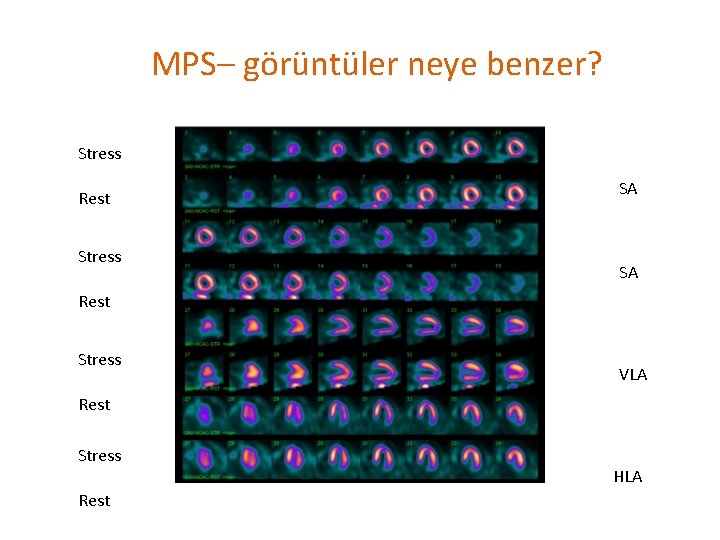 MPS– görüntüler neye benzer? Stress Rest Stress SA SA Rest Stress VLA Rest Stress