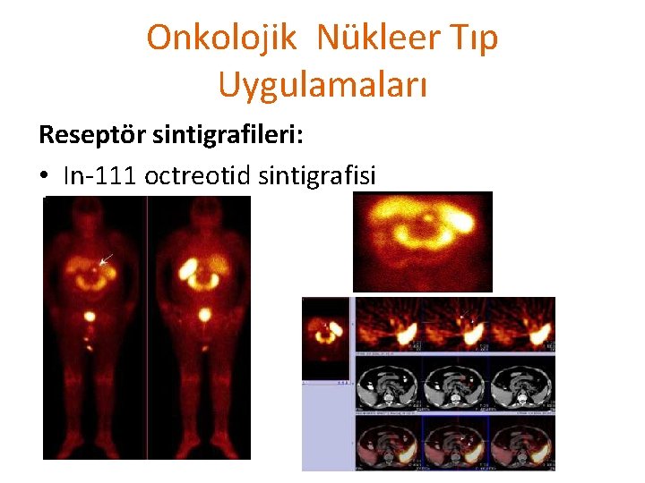 Onkolojik Nükleer Tıp Uygulamaları Reseptör sintigrafileri: • In-111 octreotid sintigrafisi 