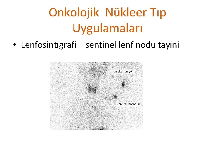 Onkolojik Nükleer Tıp Uygulamaları • Lenfosintigrafi – sentinel lenf nodu tayini 