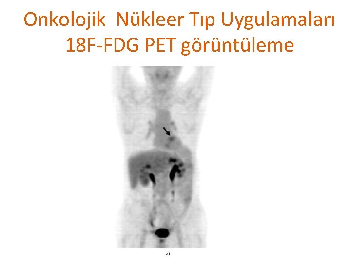 Onkolojik Nükleer Tıp Uygulamaları 18 F-FDG PET görüntüleme 