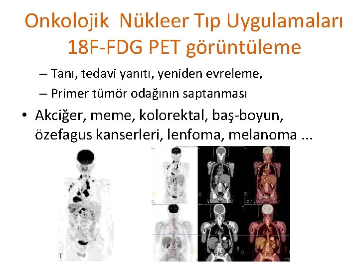 Onkolojik Nükleer Tıp Uygulamaları 18 F-FDG PET görüntüleme – Tanı, tedavi yanıtı, yeniden evreleme,