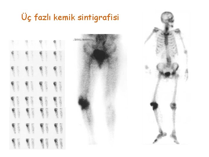 Üç fazlı kemik sintigrafisi 