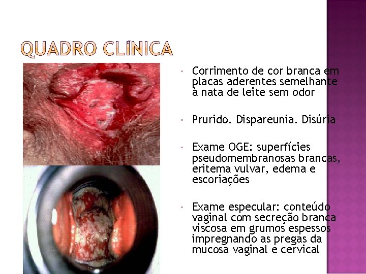  Corrimento de cor branca em placas aderentes semelhante à nata de leite sem