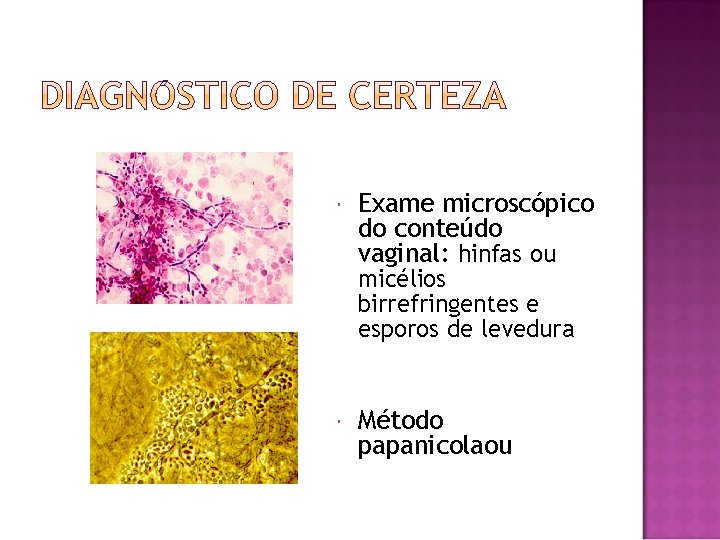  Exame microscópico do conteúdo vaginal: hinfas ou micélios birrefringentes e esporos de levedura