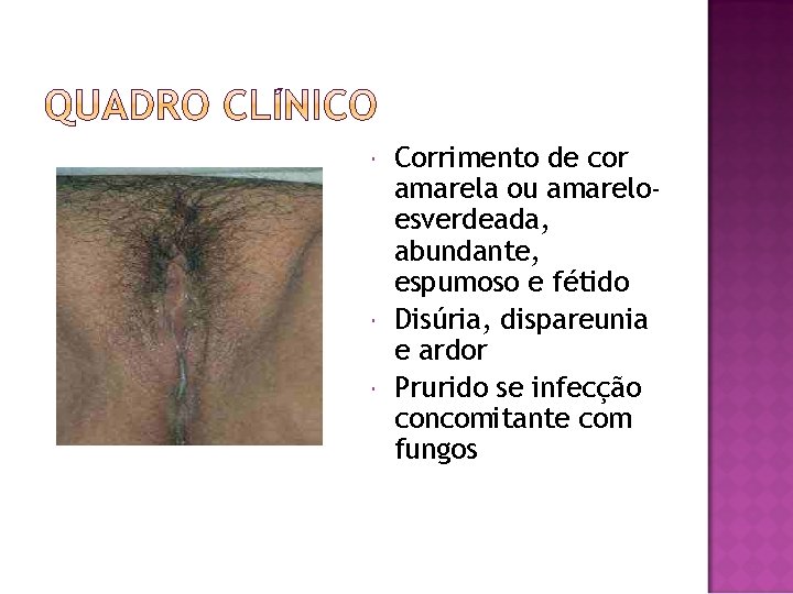 Corrimento de cor amarela ou amareloesverdeada, abundante, espumoso e fétido Disúria, dispareunia e