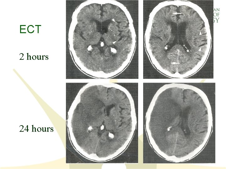 ECT 2 hours 24 hours 