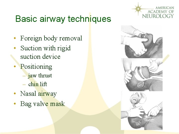 Basic airway techniques • Foreign body removal • Suction with rigid suction device •