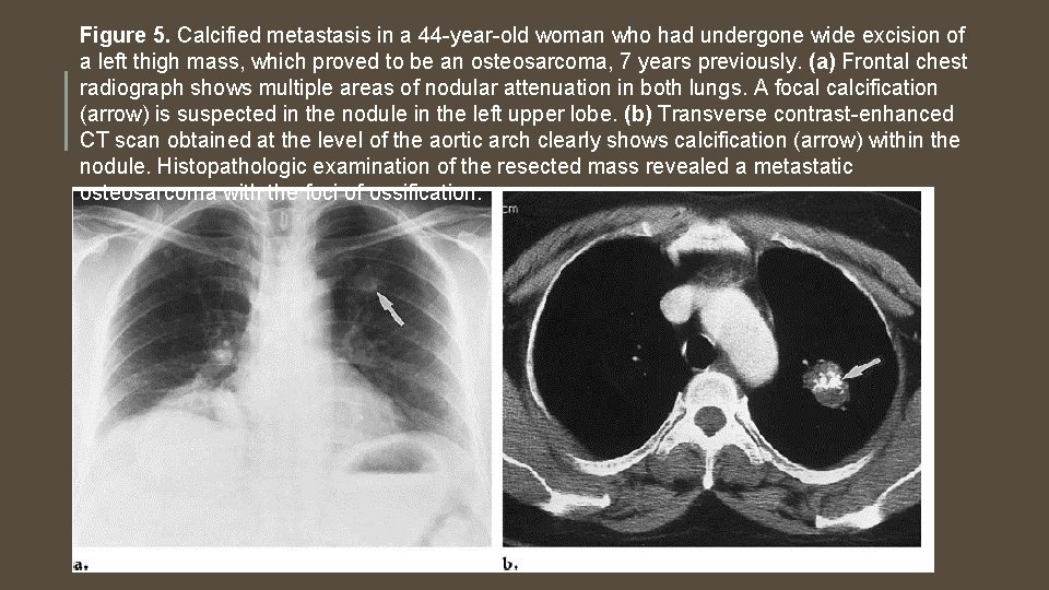 Figure 5. Calcified metastasis in a 44 -year-old woman who had undergone wide excision